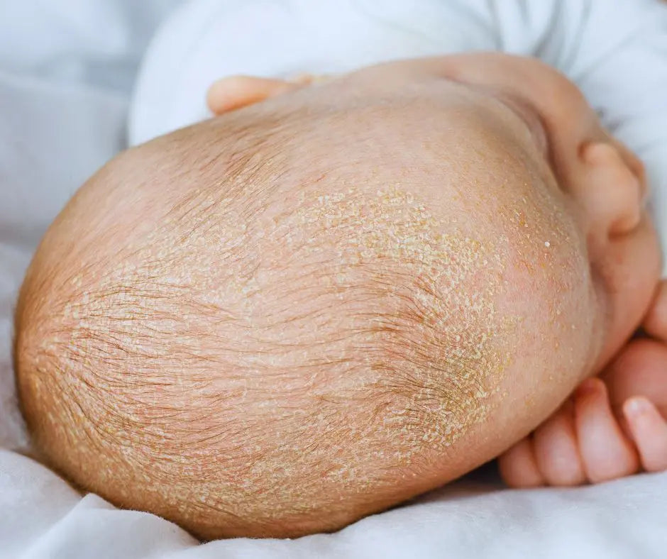 A képen egy baba fejecskéje látható, melyet száraz, lazábban elhelyezkedő koszmós pikkelyek fednek