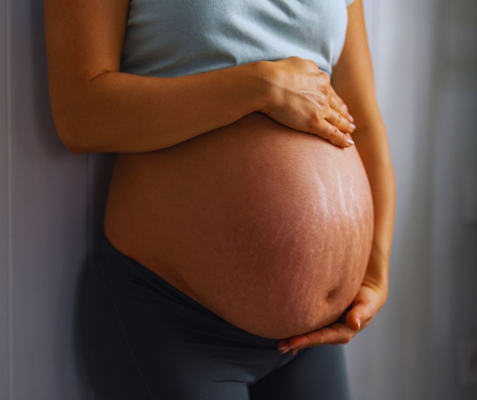 Várandósság alatt gyakran jelennek meg striák a babapocakon